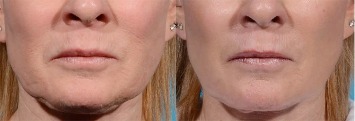 Functional Medicine Sarasota FL Microneedling Results