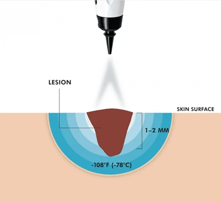 Regenerative Medicine Sarasota FL CryoProbe Model