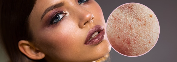 Cutera-XEO-Laser-Skin-Resurfacing-Results-With-Med-Spa